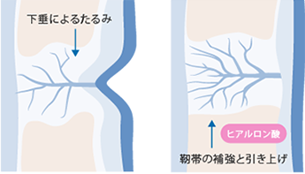 vspape
